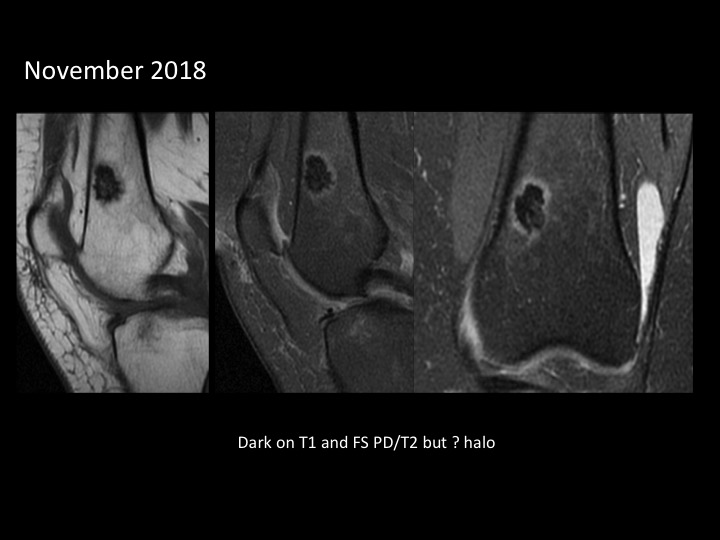 Figure 3 for case bone island ( RID4004 )